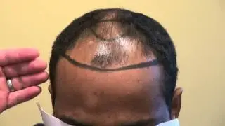 Bay Area Receding Bald Hair Loss Transplant Restoration Surgery Dr. Diep www.mhtaclinic.com