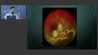 KSOS 2025  IC1  T Dr Menon Rahul Radhakrishnan  Follow up & Addressing Complications from Laser Trea
