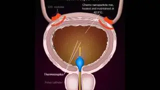 Actium Biosystems Bladder Hyperthermia Treatment 130211