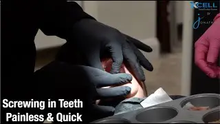 Xcell Dental Implants: PowerBall Screw Process