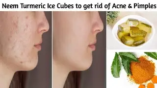 Neem Turmeric Ice Cubes to get rid of Acne, Pimples,Whiteheads, Blackheads & Open Pores in 7 Days
