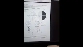 La hemianopsia y sus efectos (1/3) - Intro