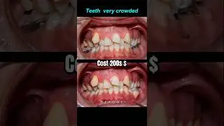 Crowded teeth Braces transformation #braces #orthodontist #dentist #bracket