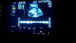 Baby Spo 20 weeks