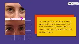 Dermal fillers in Millbrae - Reviv Med Spa & Laser Treatment