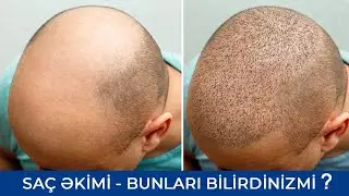 Azərbaycanda Saç Əkimi - Bilməli olduğunuz hər şey - Ramil Qocayev (Dermatoveneroloq-kosmetoloq)