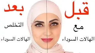 طريقة التخلص من الهالات السوداء سريعا وبشكل طبيعي