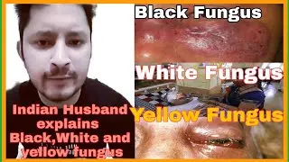 Epidemic in India+Indian Husband Explains  Black,White and yellow fungus