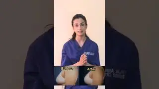 Can fat grafting increase cup size? #drhirraalavi #shorts #breastaugmentation #boobjob