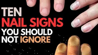Nail Signs which can tell about your health #nailhealth #skincare #nails
