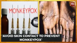 Monkeypox Alert: Medical Experts Open Up About Cause, Symptoms & Precautions Of Virus