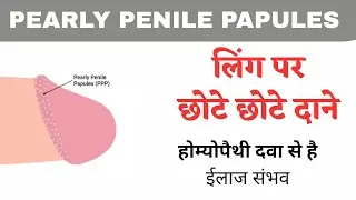 White pimples on penis. Pearly penile papules homeopathy treatment