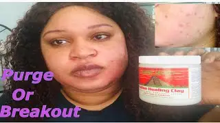 #indianhealingclay #skincare #breakout       IS MY SKIN PURGING OR BREAKING OUT