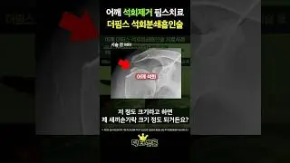 🔍【치료환자사례】어깨 석회성건염 더핌스(+PIMS) 석회분쇄흡인술 치료 후 변화｜📚내가 알려줄게! 닥터발룬TV #석회성건염 #어깨통증 #핌스치료 #shorts