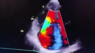 Picture suggestive of Restrictive Cardiomyopathy,BiAtrial enlargement,SevereMR,Severe TR,Severe PHTN