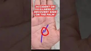 Accident or illness recovery sign on the palm| Astrologer Santoshi| #palmistry #astrology #shorts