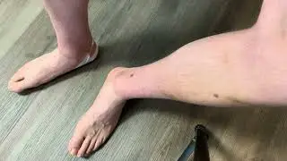 Lateral ankle ER and medial mid foot ER taping