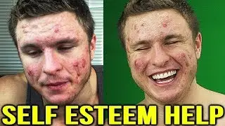 ACNE & DEPRESSION | What Can Help & My Story