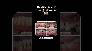 #high risk of using tobacco #explorepage #shortsfeed