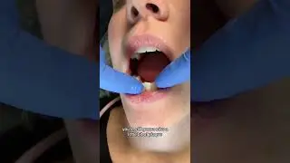 Why Do I Need A Dental Cleaning Every 6 Months?