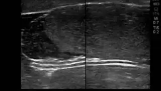 Scrotal Ultrasound Training Model