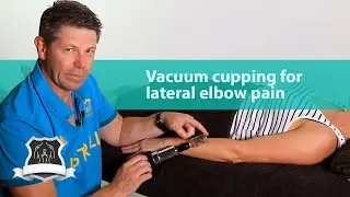 Vacuum cupping for lateral elbow pain