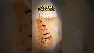 Get Rid Of Black Heads With An Egg Mask