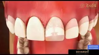 ADVANCED LASER GINGIVECTOMY/ GUMMY SMILE TREATMENT/ COSMETIC SMILE MAKEOVER