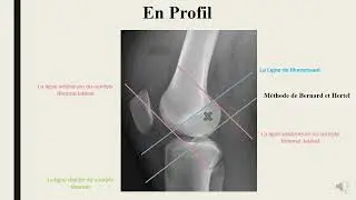 Reconstruction du LCA : repères sur clichés standards 