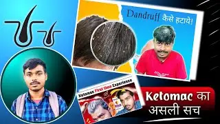 How to Reduce Dandruff in Hair || Ketomac का असली सच & Real Life Experience 2023 #Quick_Hairstyle