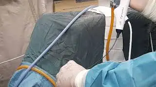 Flexible endoscopy to visualize renal pyelocalyces