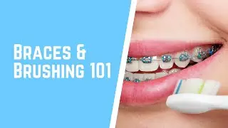 Braces & Brushing 101: What Happens When You Don't Brush Well Enough With Braces