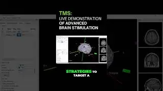 Inside a Real TMS Session: See Brain Stimulation in Action