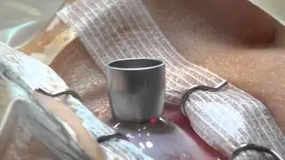 Advanced surface ablation (PRK) with close-up (EX500 excimer laser)