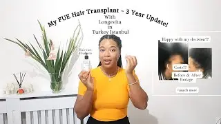 Sooo, it's been 3 years since my FUE Hair Transplant with Longevita - Turkey Istanbul