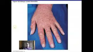 Ch 19 Disorders Associated with the Immune System
