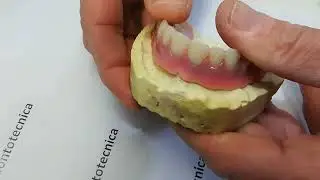 Implantologia protesica, protesi implantare amovibile su una barra avvitata