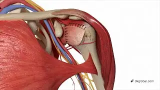 Surgeon Neglectfully Destroys Blood Vessels During Routine Surgery Causing Arm Amputation