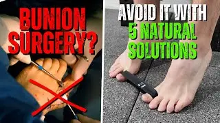 No Bunion Surgery Required. SENIORS must try these 5 NATURAL treatments first