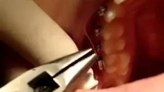 Home Emergency Braces Repair (Part 4)
