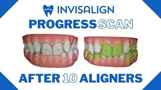 Invisalign Update | Progress Scan After 10 Aligners | Invisalign Journey India