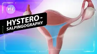 Diagnosing blocked fallopian tubes (3D Animation)