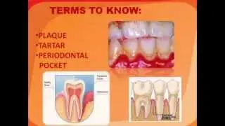Heart Disease and Dental Health