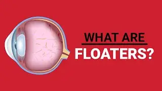 What Retinal Floaters Are and How a Vitrectomy Works