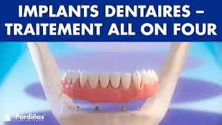 Implant dentaire &ndash; Traitement All On Four &copy;