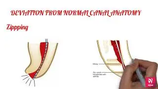 PROCEDURAL ERRORS IN ENDODONTICS