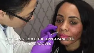 PRP Injections after MicroNeedling