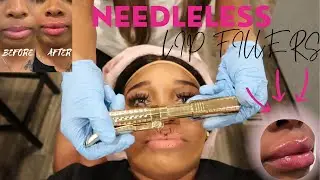 GETTING MY LIPS DONE🖊️👄Hyaluron Pen Lip Fillers, Very Detailed, Painless