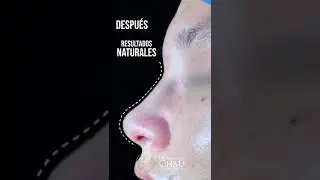 Dr. Enrique Chau - Rinoplastia 3D l&aacute;ser