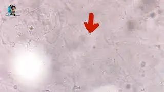 Identification of Crystals in Urine (Urine Routine Examination)